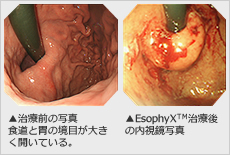 患者さんの内視鏡写真
